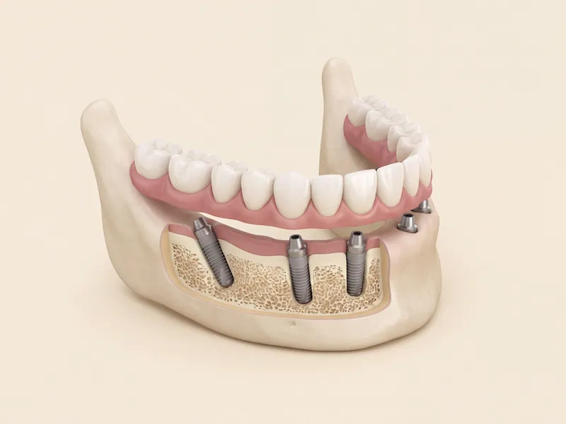 Illustration of a full arch restoration supported by multiple dental implants